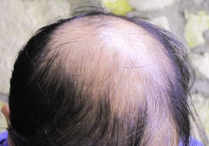 Exoderm Nido hair implant