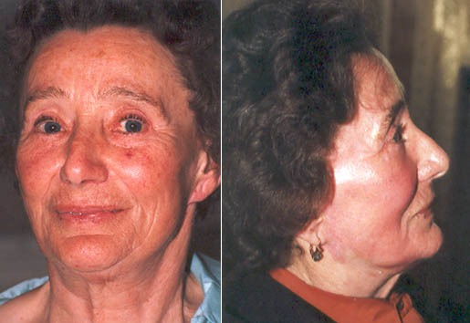 Exoderm peel