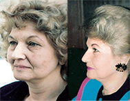 Exodem peel
