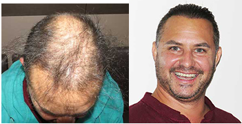 Exoderm Hair implants 